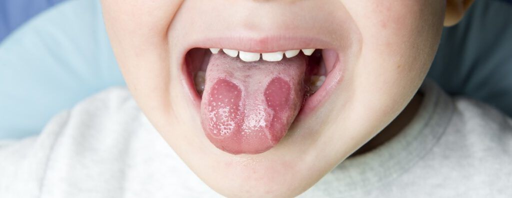 ¿qué Son Las Manchas Rojas En La Lengua Clínica Dental Jiménez Cameán