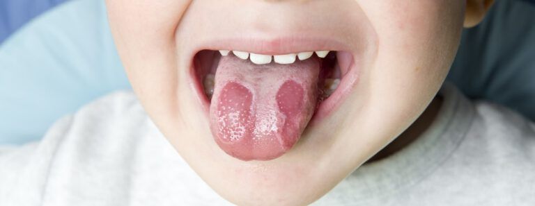 manchas rojas en la lengua que no duelen